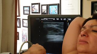 Biopsia o punción de Quiste en pecho o seno