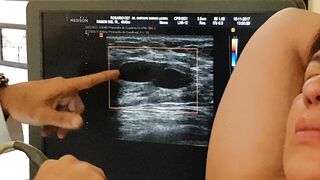 Biopsia o punción de Quiste en pecho o seno