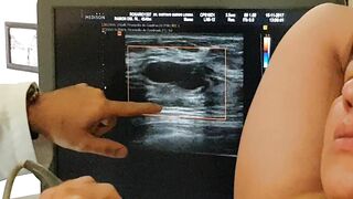 Biopsia o punción de Quiste en pecho o seno