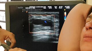 Biopsia o punción de Quiste en pecho o seno