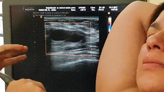 Biopsia o punción de Quiste en pecho o seno