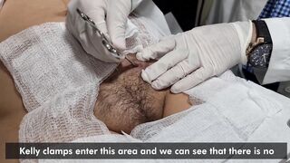 Drainage of a seroma