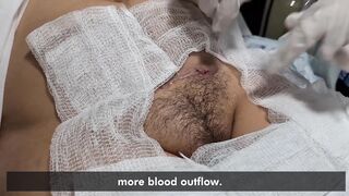 Drainage of a seroma