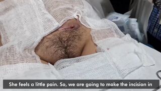 Drainage of a seroma