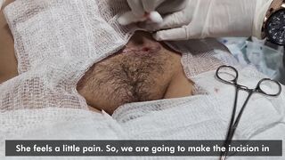 Drainage of a seroma