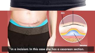 Drainage of a seroma