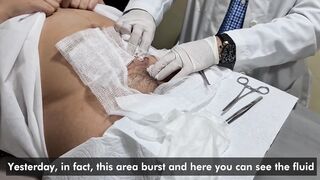 Drainage of a seroma