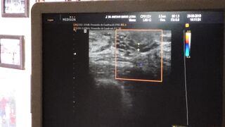 Prolactinemia o salida de líquido por el pezón