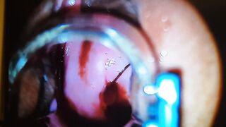 Retiro de Dispositivo intrauterino