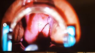 Retiro de Dispositivo intrauterino