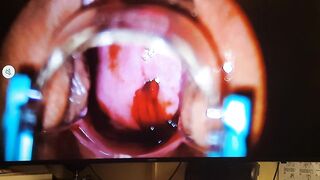 Retiro de Dispositivo intrauterino
